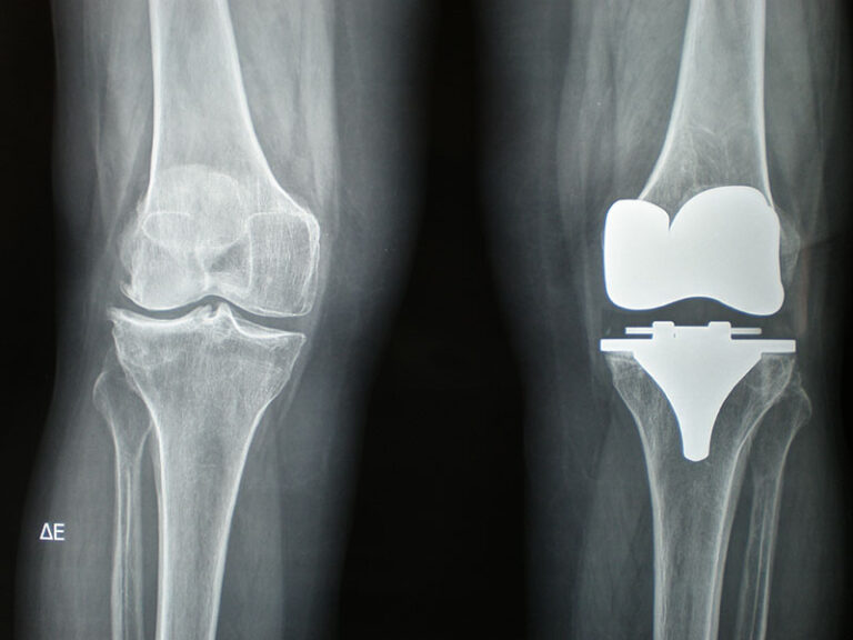 Οστεοαρθρίτιδα γόνατος – Ολική αρθροπλαστική γόνατος