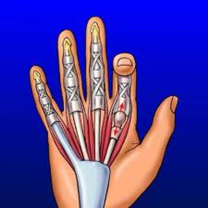 Στενωτική τενοντοελυτρίτιδα ή εκτινασσόμενος δάκτυλος ή trigger finger ( thumb )